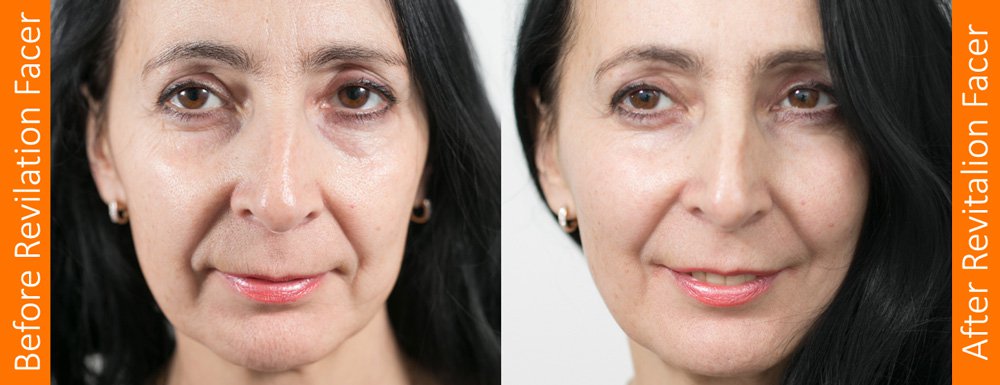Before and After Revitalion Facer